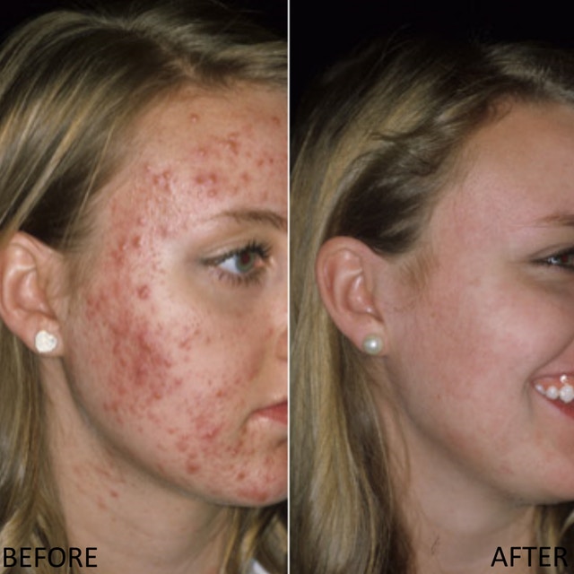 tretinoin burn scars